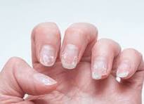 Vitamin C deficiency symptom - nail cracking