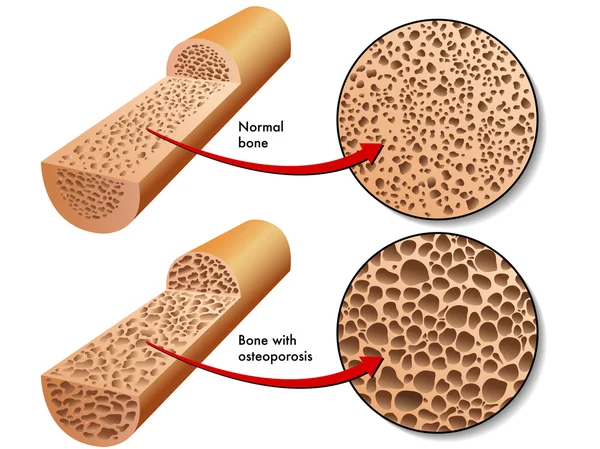 Vitamin D deficiency symptom