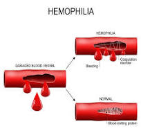 Vitamin E health hazard - excess Vitamin E - hemophilia - bleeding disorder