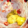 atherosclerosis / cholesterol buildup/ lipoproteinemia