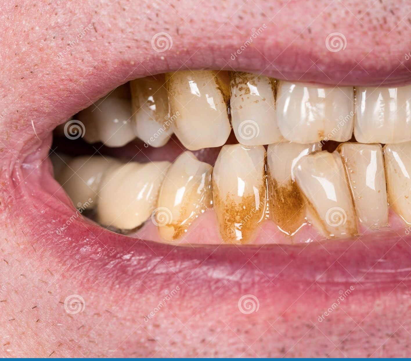 Vitamin E deficiency symptom - teeth discoloration