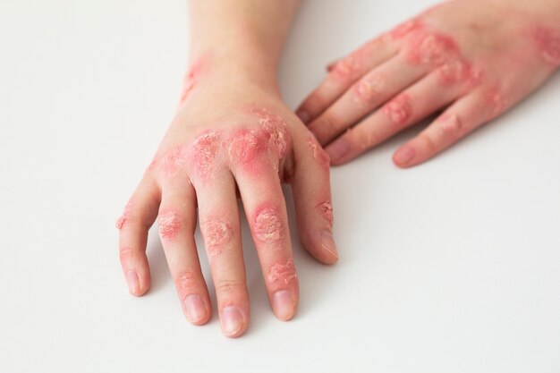 zinc deficiency symptom: eczema