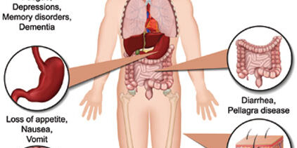 Niacin Deficiency symptoms