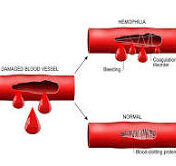 calcium deficiency disorder - coagulopathy