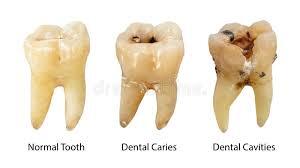 tooth decay - calcium deficiency symptom